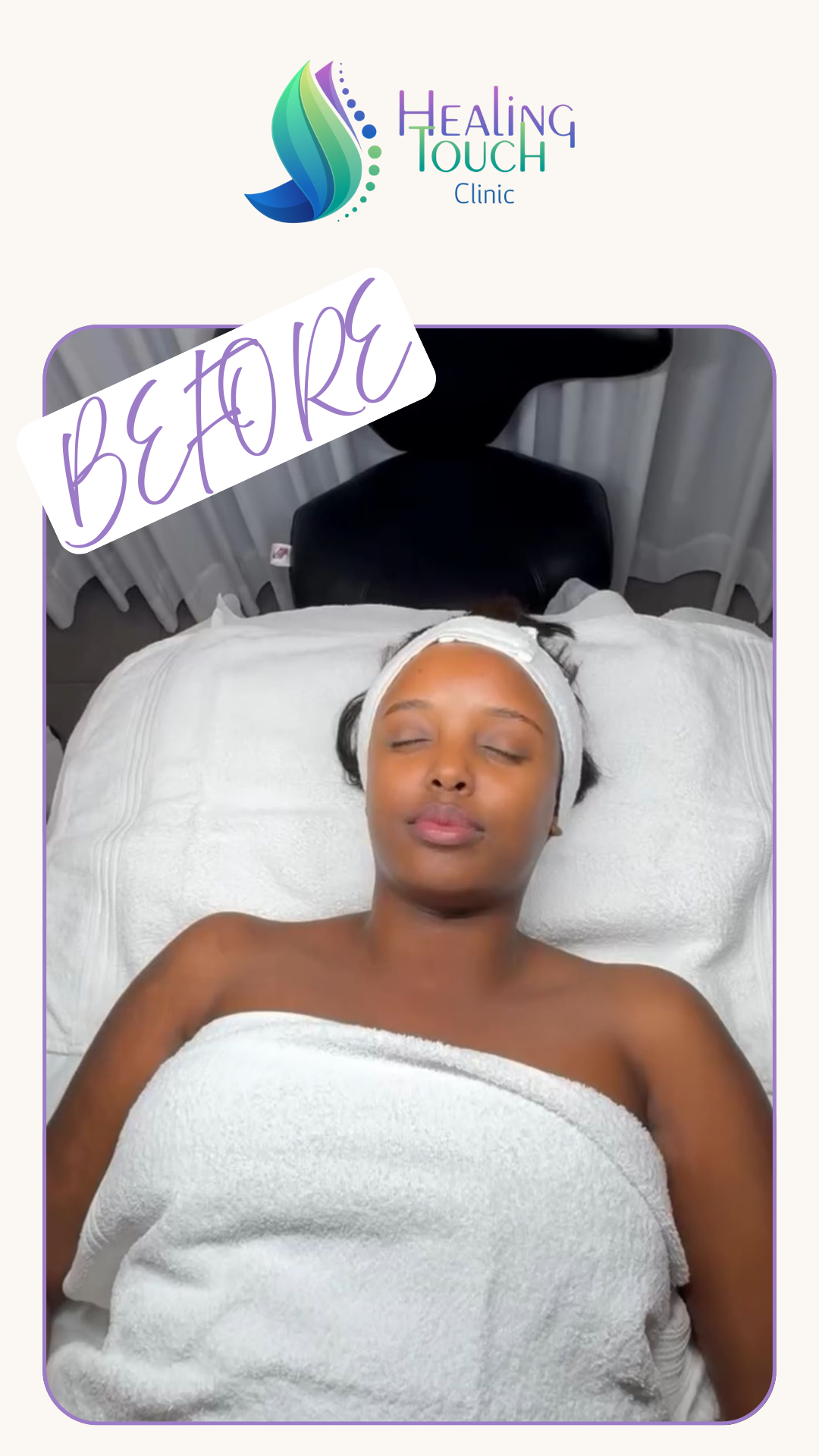 טמפלט לפני אלירן קרסו HT CLINIC (1)